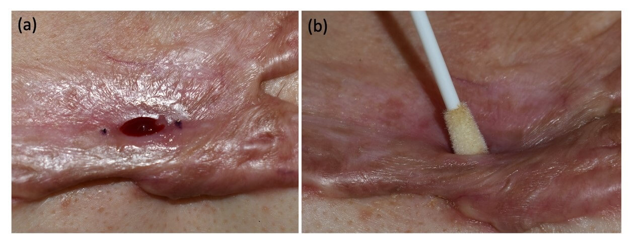化膿性蟹足腫之瘻管開口