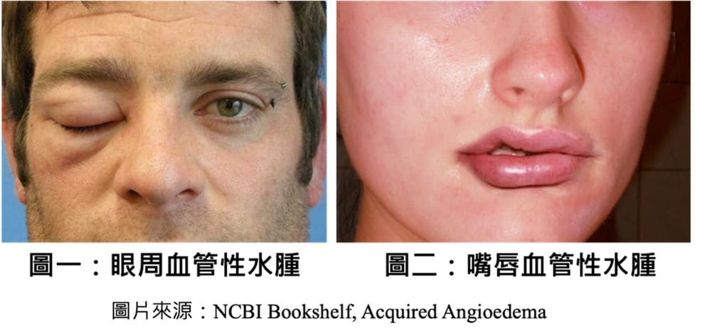 12 血管性水腫示意圖 血管性水腫示意圖