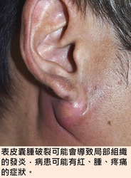 表皮囊腫破裂可能會導致局部組織的發炎,病患可能有紅、腫、疼痛的症狀